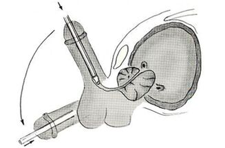 Schema der endoskopischen Penisvergrößerungsoperation
