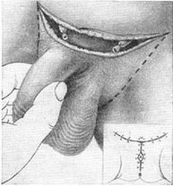 Chirurgische Verlängerung des Penis durch Herausziehen des verborgenen Teils