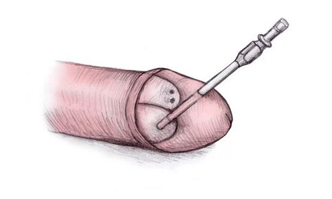 Der Peniskopf kann durch die Injektion von Hyalurongel vergrößert werden